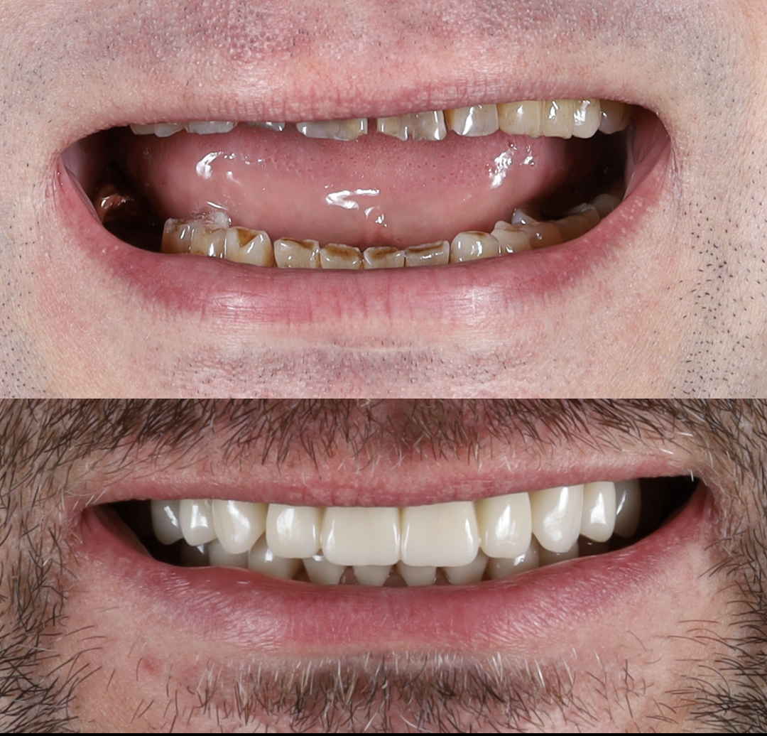 Comparison of a person's teeth before and after dental whitening and complex prosthodontic restorations. The top image shows stained and discolored and worn down teeth, while the bottom image shows teeth that are healthier, brighter and whiter.