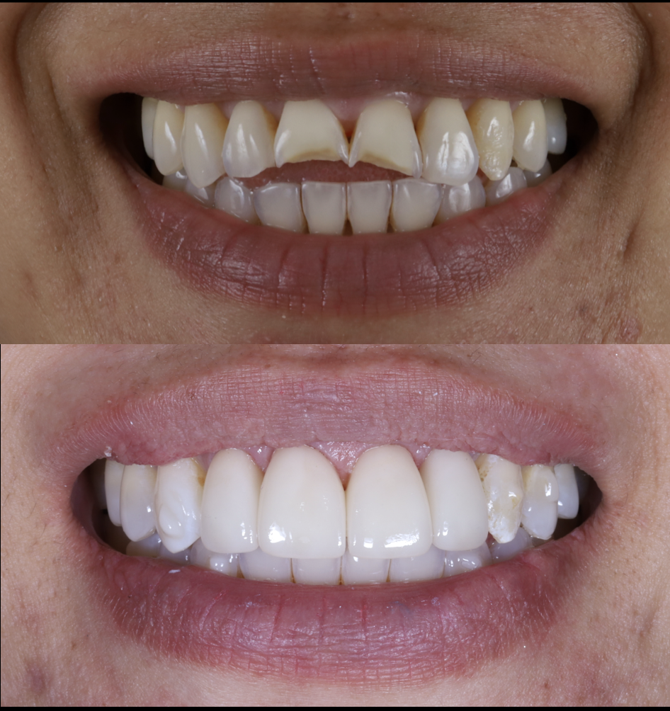 Comparison of teeth before and after complex prosthodontic dental treatment showing improved whiteness, alignment, and appearance.