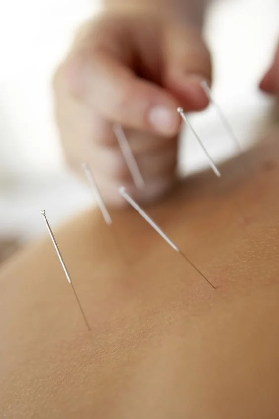 ACUPUNCTURE (45 minutes)
