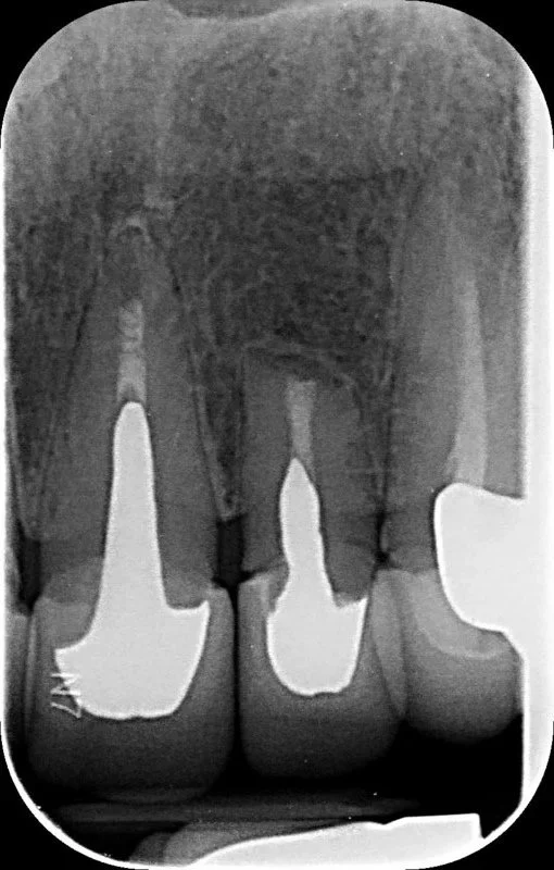 18 months after apicectomy