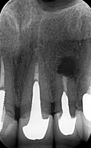Surgical treatment (apicectomy)