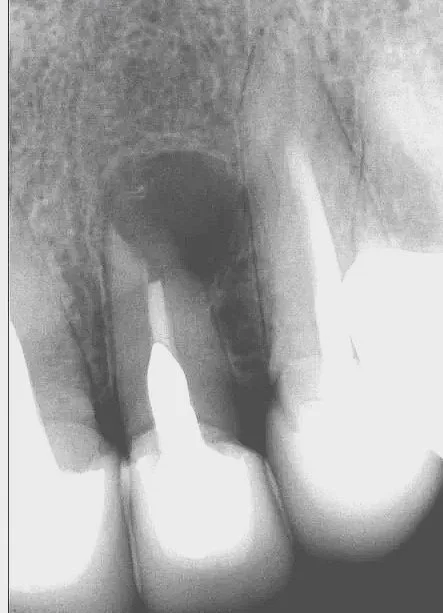 Infection in tooth