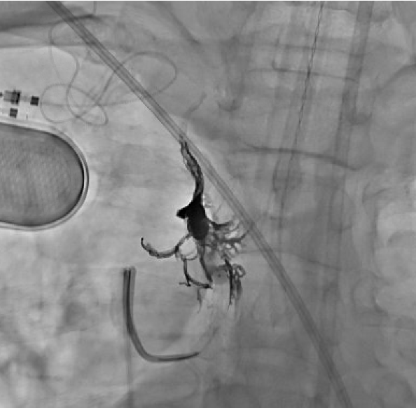 X-ray image of catheter-based embolization of a CSF-venous fistula
