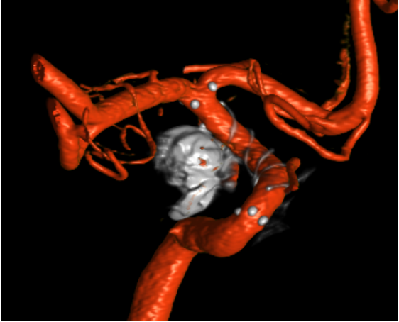 3D reconstruction of brain blood vessels showing a cerebral aneurysm