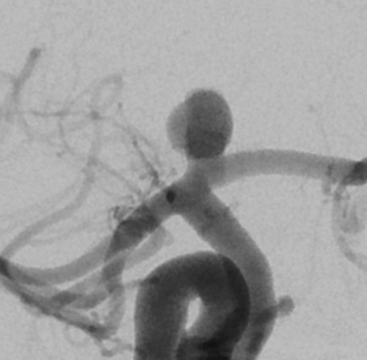 Cerebral angiogram of a brain aneurysm