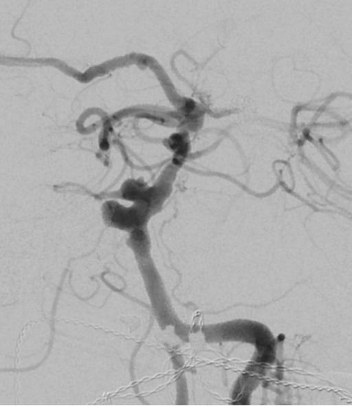 Cerebral angiogram showing a brain aneurysm and surrounding arteries