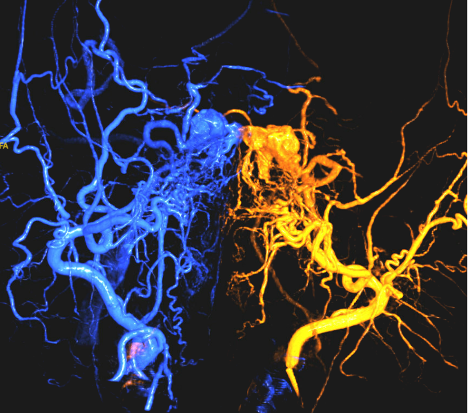 3D angiogram of brain blood vessels showing a carotid-cavernous fistula