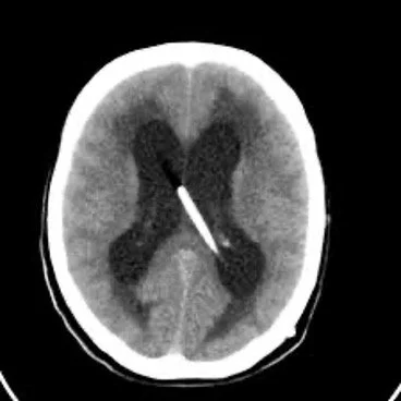 CT scan showing a shunt catheter in the brain ventricles for hydrocephalus