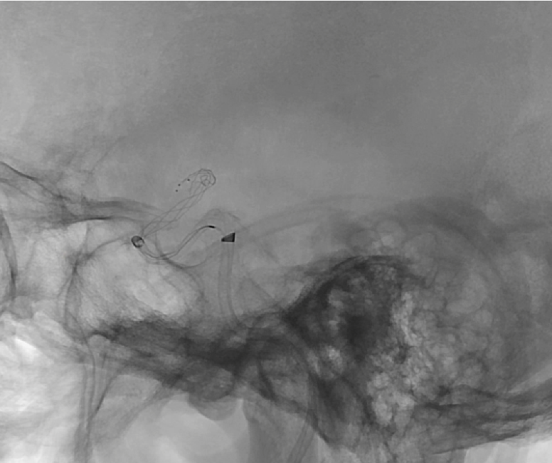 X-ray image taken during a mechanical thrombectomy for stroke