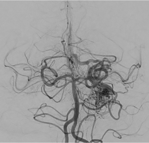 Illustration of a brain arteriovenous malformation (AVM)