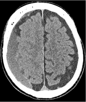 CT scan showing a chronic subdural hematoma