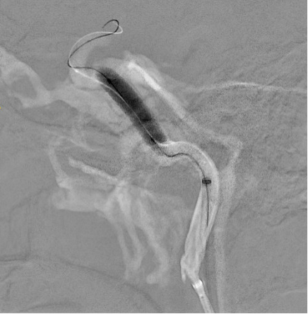 X-ray image of a balloon and stent being placed through a catheter