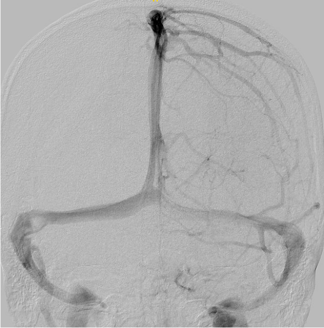 Venous-phase angiogram showing the brain's draining veins and venous sinuses