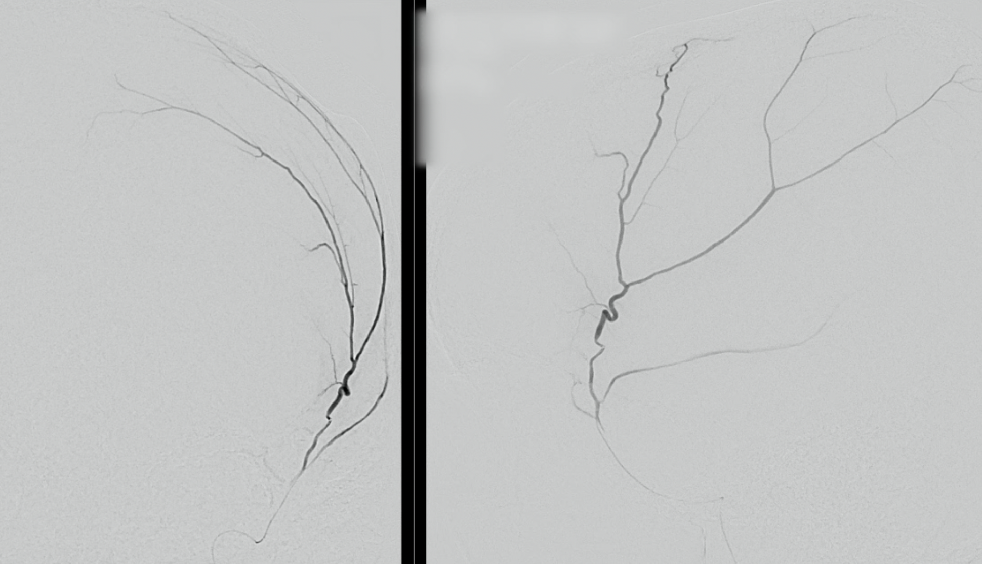 Angiogram of the middle meningeal artery used in MMA embolization for subdural hematoma