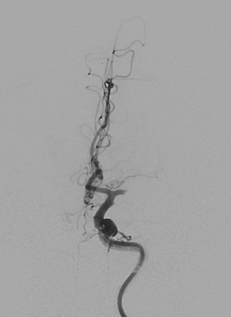 Cerebral angiogram showing a blocked brain artery during a stroke