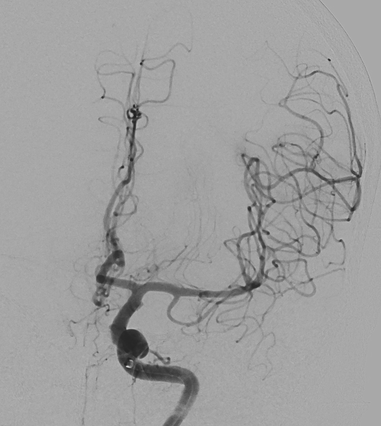 Cerebral angiogram after thrombectomy showing restored blood flow