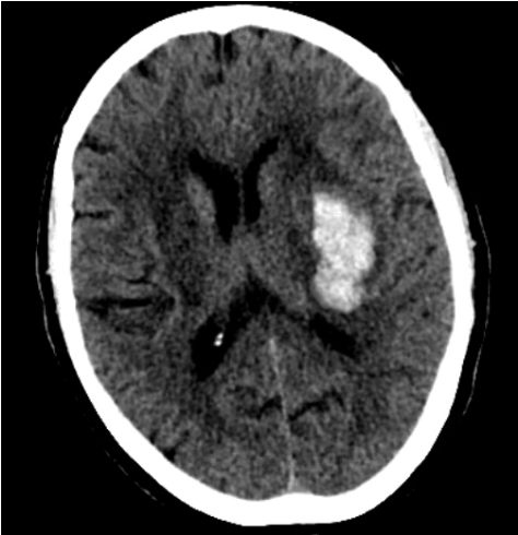 Brain CT scan showing an intracerebral hemorrhage