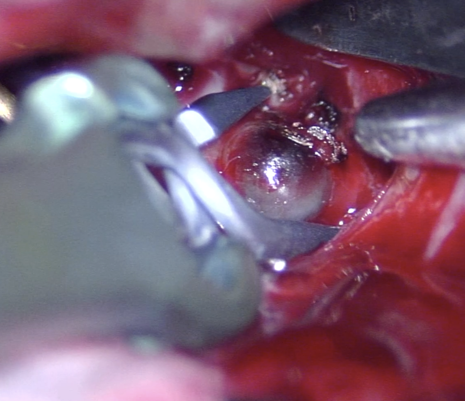 Microsurgical view of brain aneurysm clipping