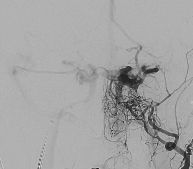 Angiogram of a carotid-cavernous fistula