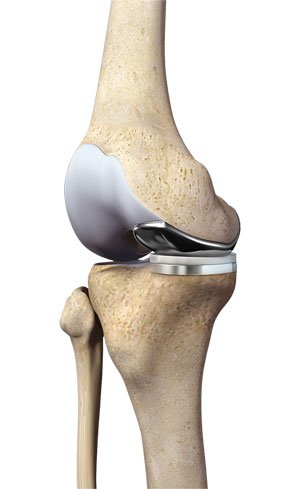 A medical illustration of a knee joint showing a knee replacement with an artificial implant.