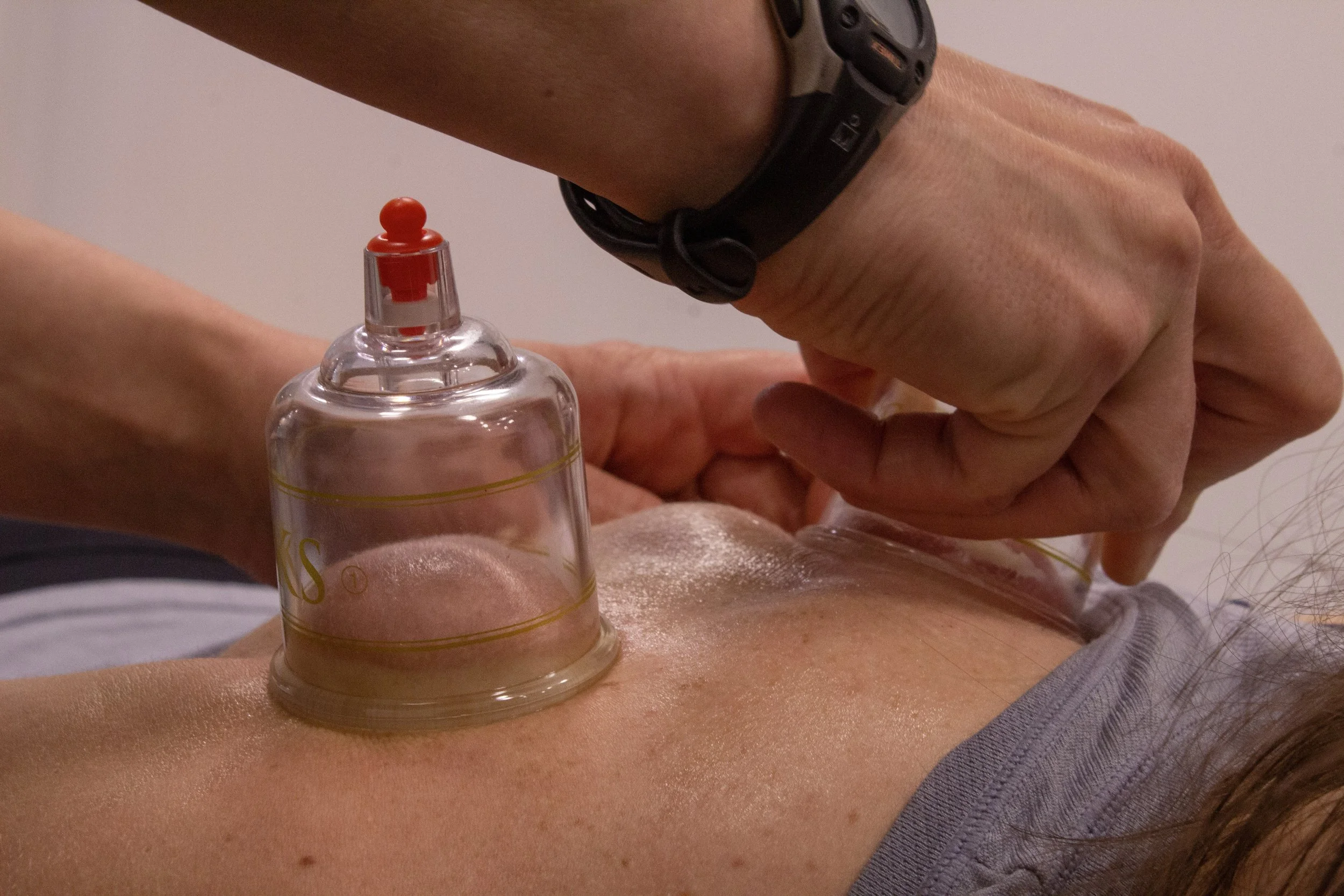 Physical Therapist performs cupping to patient