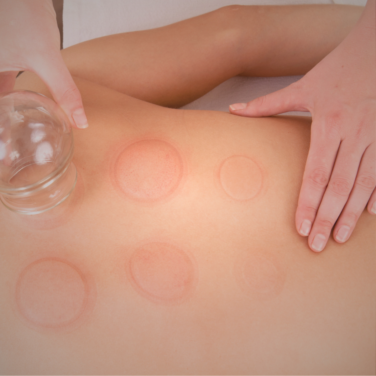 Person receiving cupping therapy on back with transparent cups, creating circular red marks.