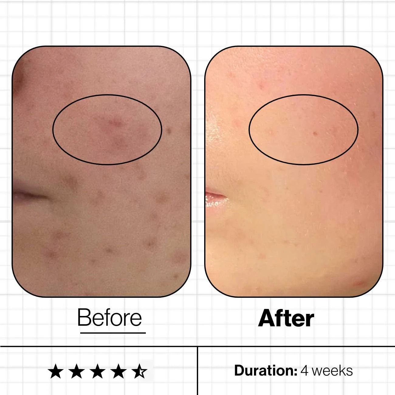 Advanced Nutrition Programme - Comparison of skin before and after a 4-week treatment showing reduction in acne and skin blemishes.
