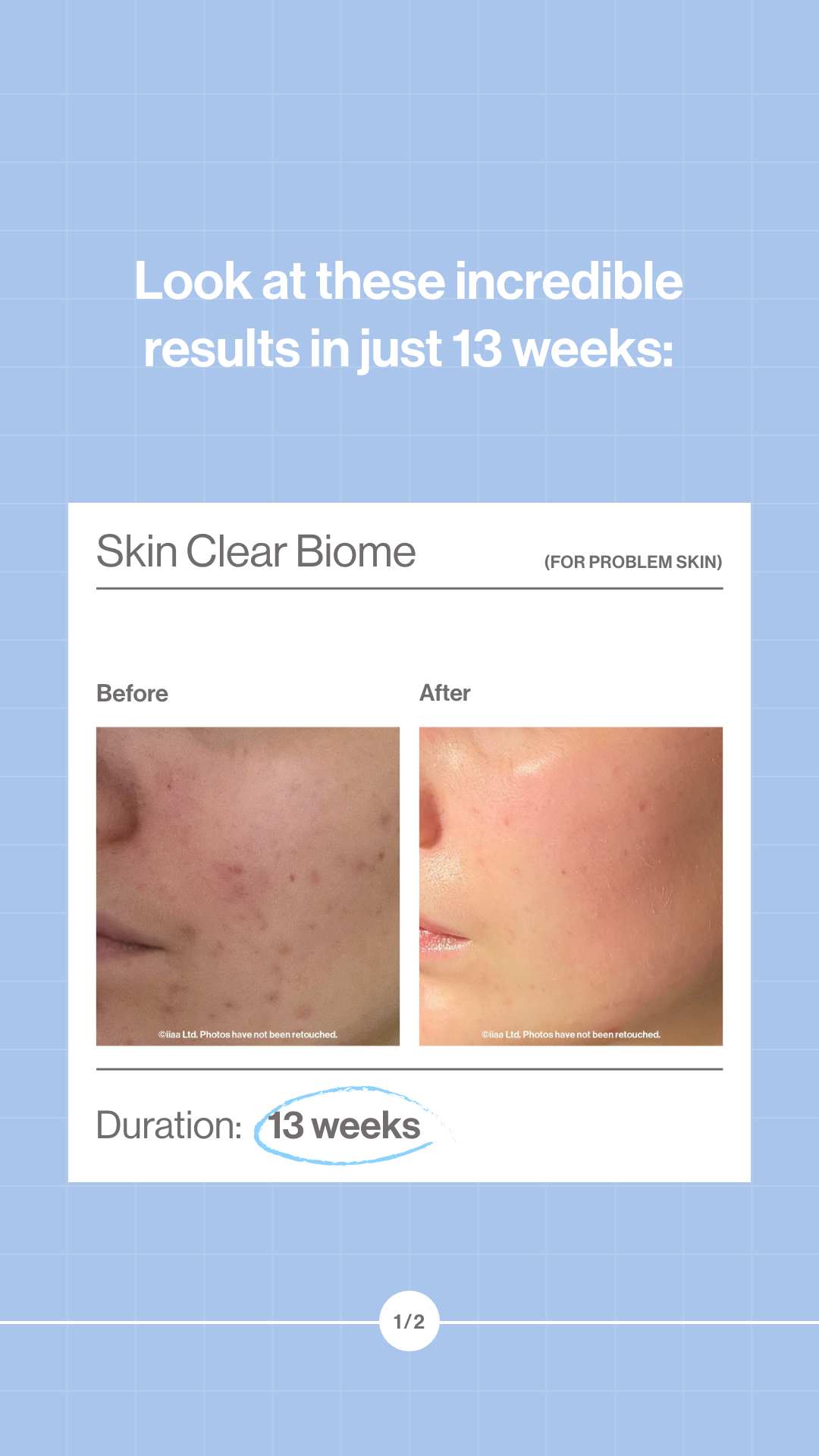 An advertisement showing a skin treatment for problem skin with before and after photos. The before photo shows skin with acne scars and redness, and the after photo shows clearer, smoother skin. The text highlights results after 13 weeks.