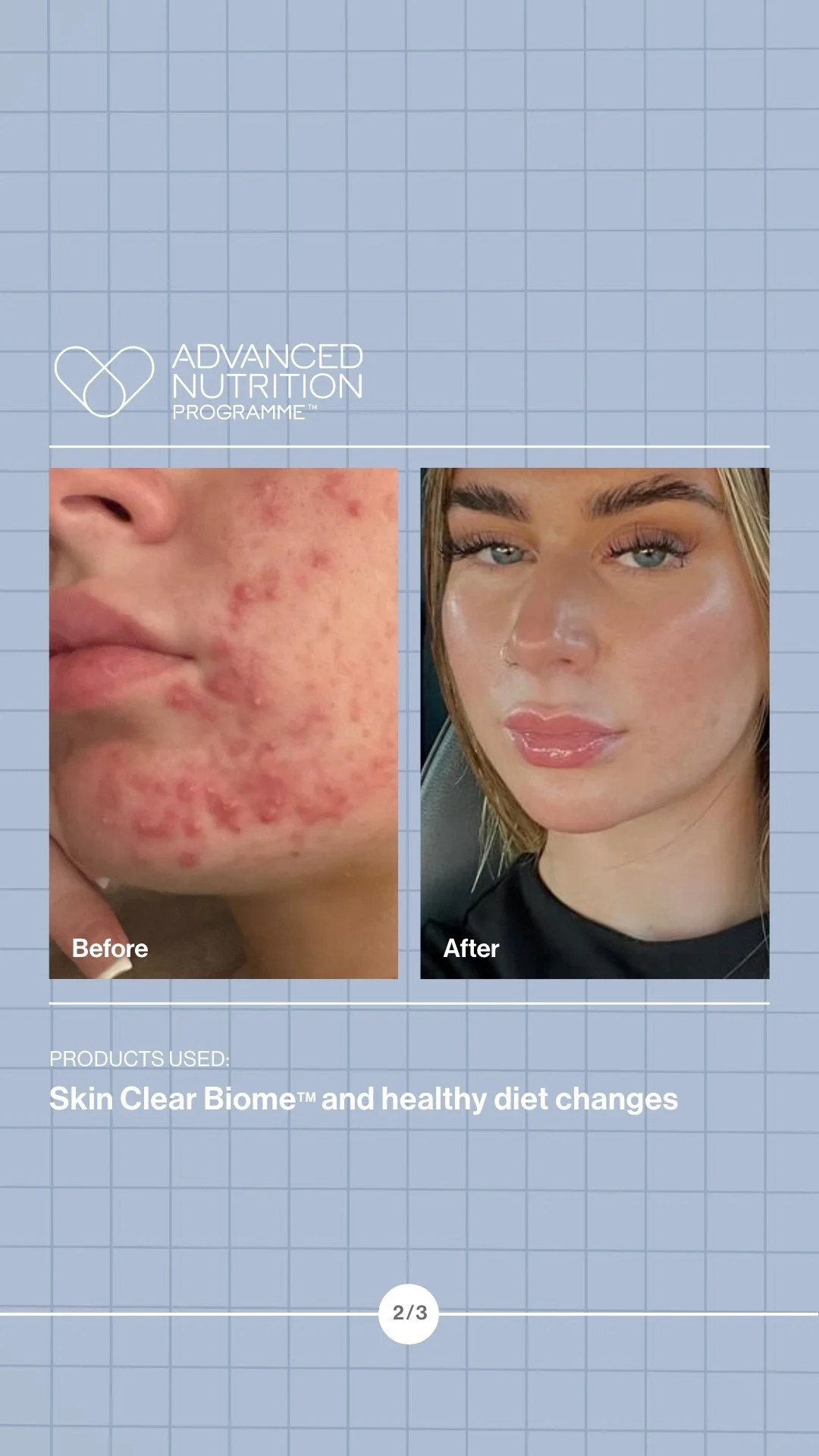 Side-by-side comparison of a woman's face showing severe acne on the left and clear skin on the right, with the text 'Before' under the acne and 'After' under the clear skin. The background features a light blue grid pattern with the words 'Advanced 