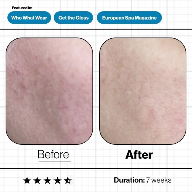 Advanced Nutrition Programme - Comparison of skin showing a 'Before' and 'After' of skincare results, with clearer skin in the 'After' image, indicating improvement over 7 weeks.