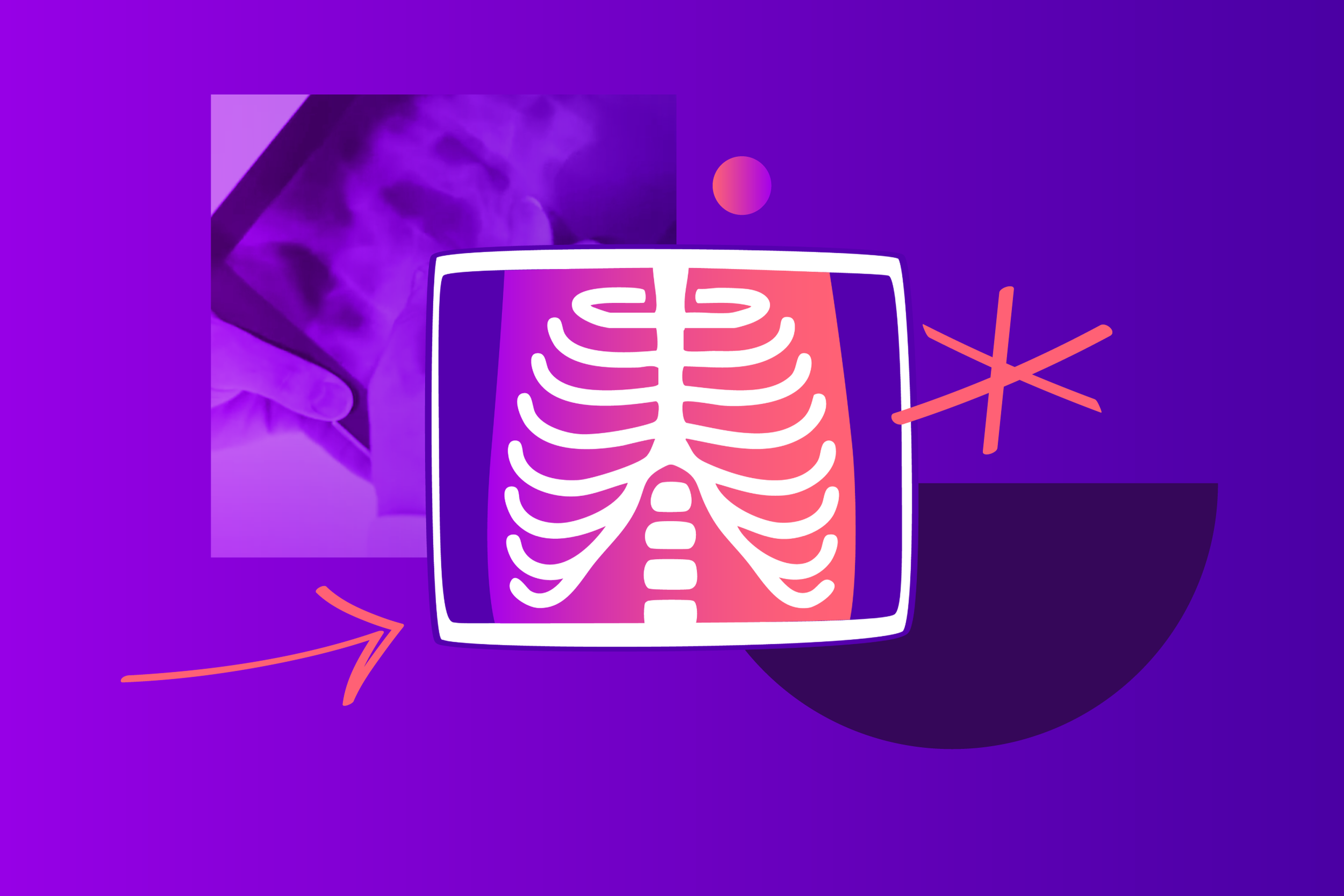 Illustration of a skeleton rib cage collage with an X-ray photograph annotated with a pink arrow and asterisk on a purple background