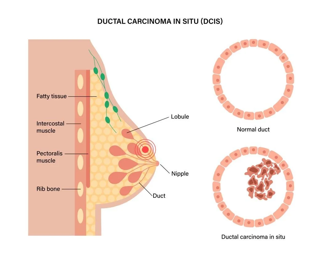 Diagram showing ductal carcinoma in situ (DCIS) of the breast. It includes a cross-section of a normal duct with healthy cells and a duct with carcinoma, showing cancerous cells. The illustration highlights the progression from normal duct to ductal carcinoma in situ, with labels for fatty tissue, intercostal muscle, pectoralis muscle, rib bone, lobule, nipple, and duct.