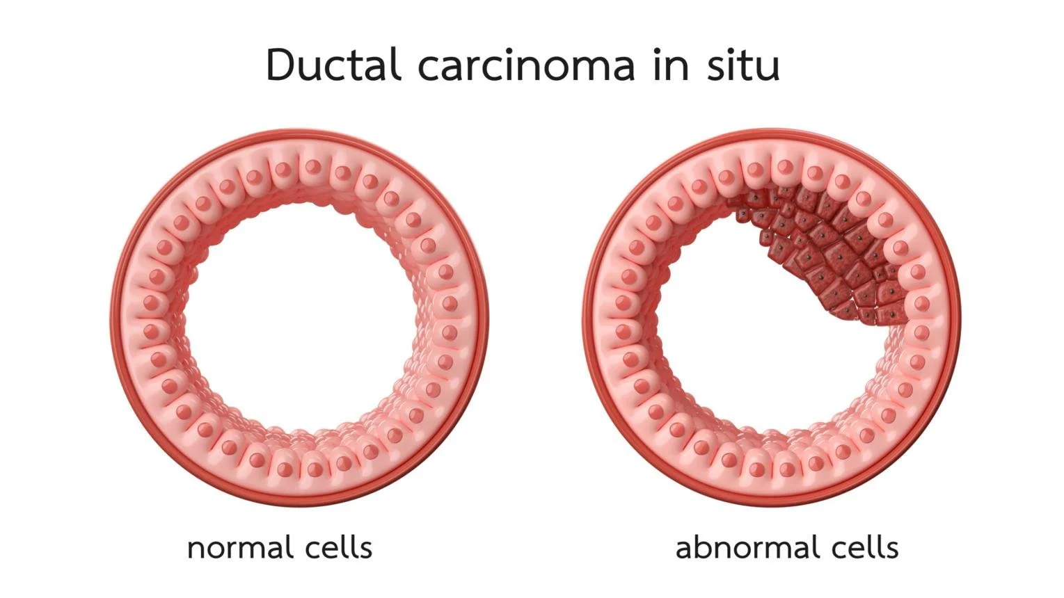 Illustration showing ductal carcinoma in situ, with a comparison between normal cells forming a uniform ring and abnormal cells forming an irregular, dense cluster inside the ring.