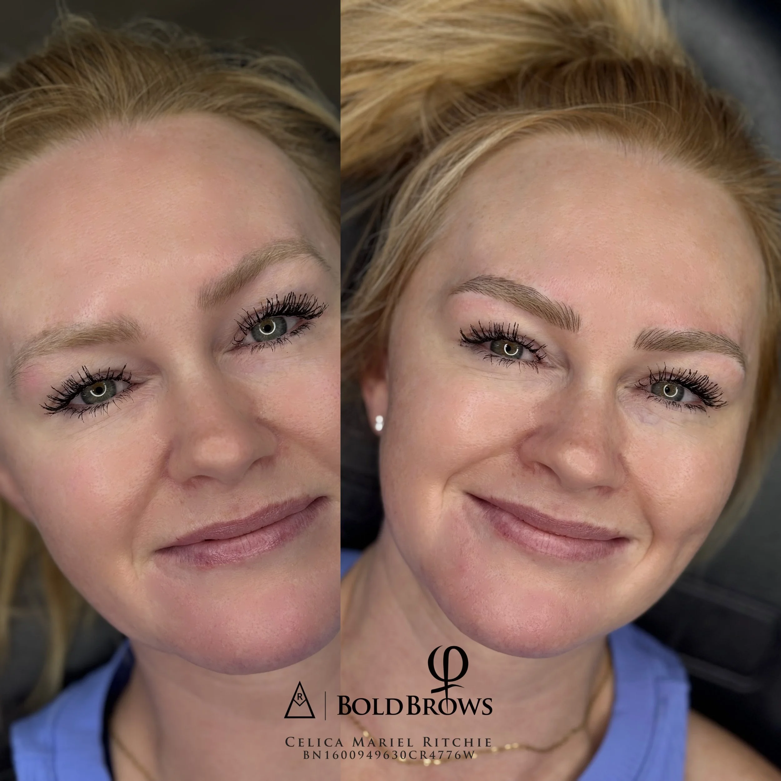 Brow Correction