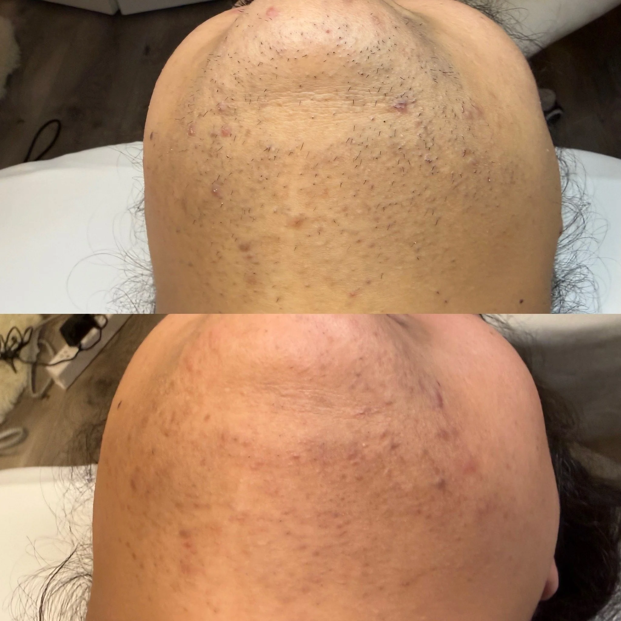 Close-up of a person's scalp showing multiple hair transplant stitches and small scabs with short hair sprouts.