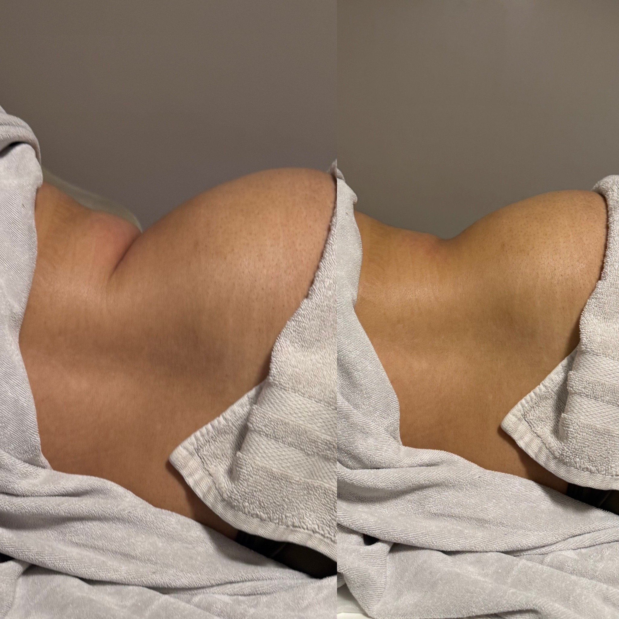 Close-up of a person's thigh resting on a white textured towel or cloth.