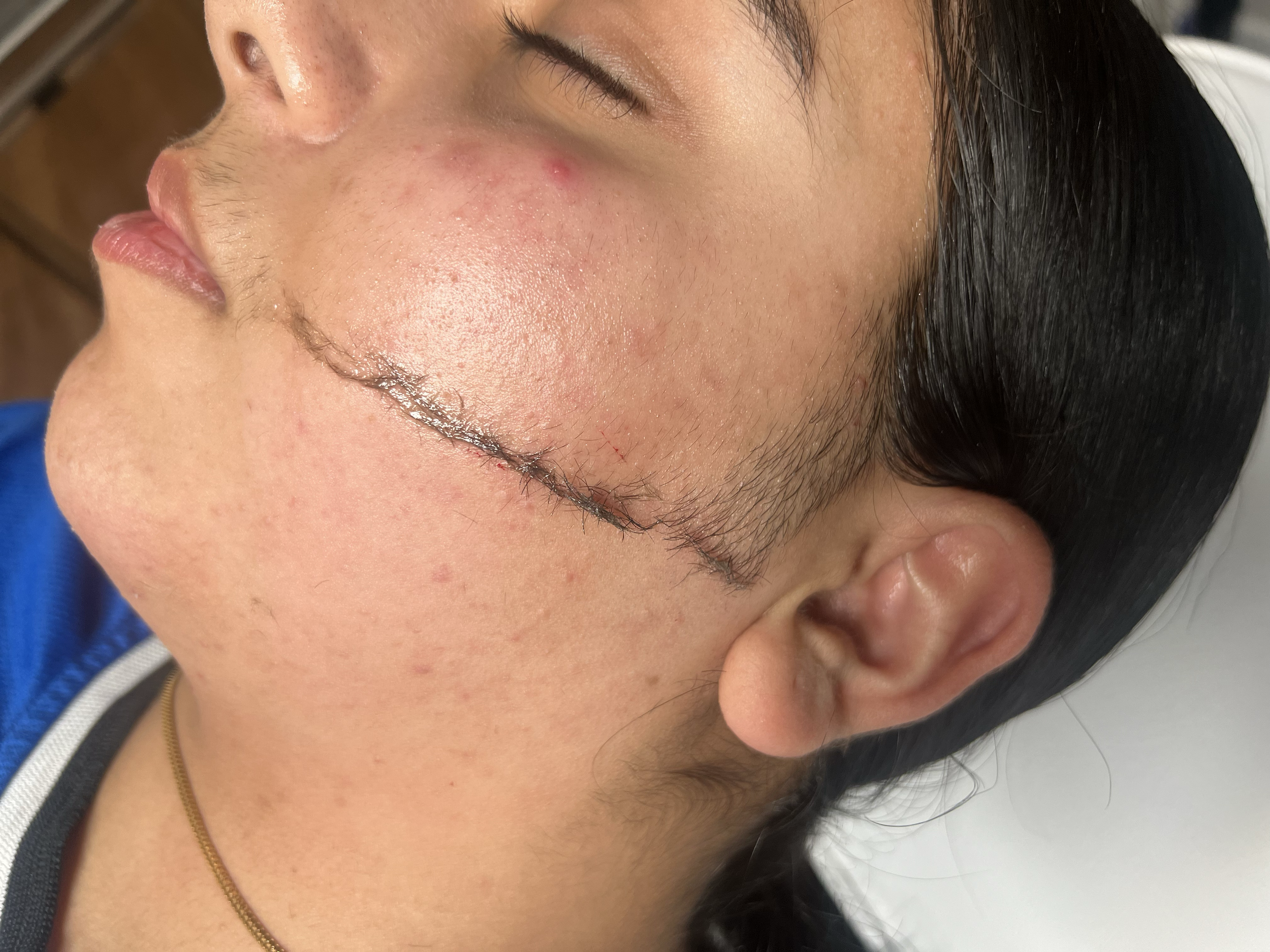 Close-up of a person's face with acne and blemishes, with closed eyes and dark hair.