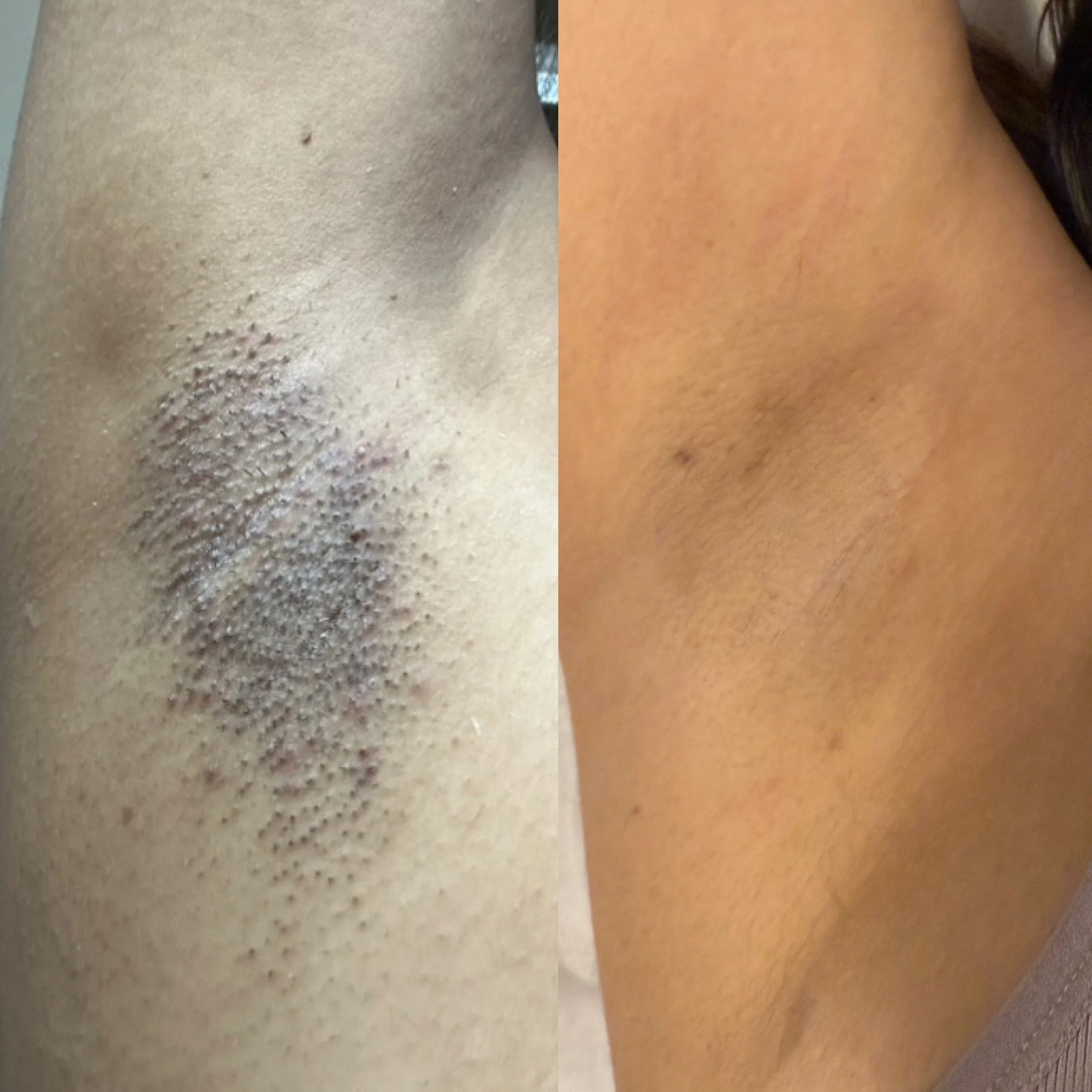 Comparison of skin before and after treatment, showing smoother skin with fewer blemishes on the right side.