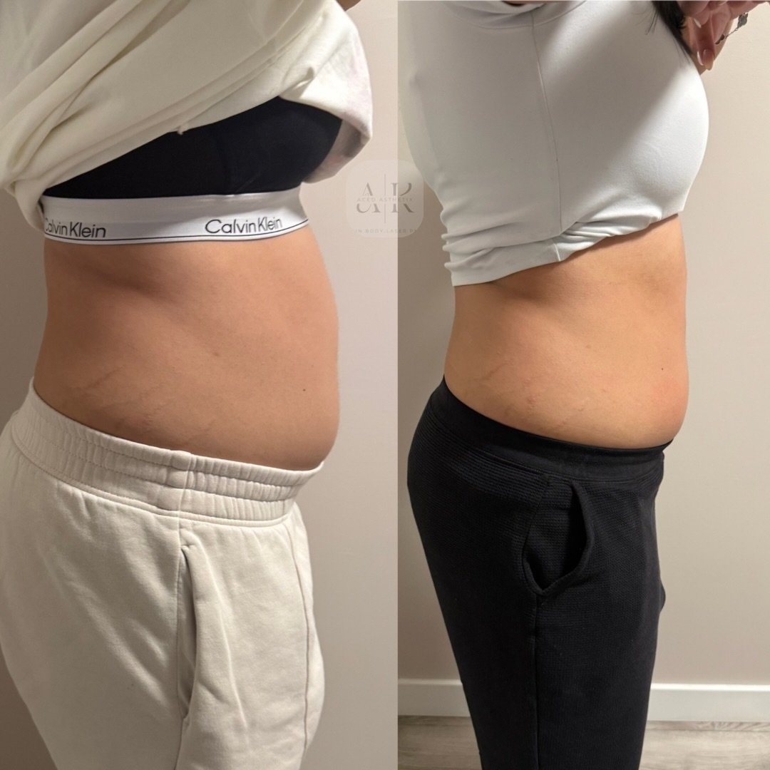 SUMMER SNATCH SEASON is officially here ☀️✨

Snatched waist. Sculpted curves. Glowing skin. Confidence on 100.
This is your reminder that the best investment you can make this summer is YOU 🤍

Whether you&rsquo;re booking body sculpting, facials, sk
