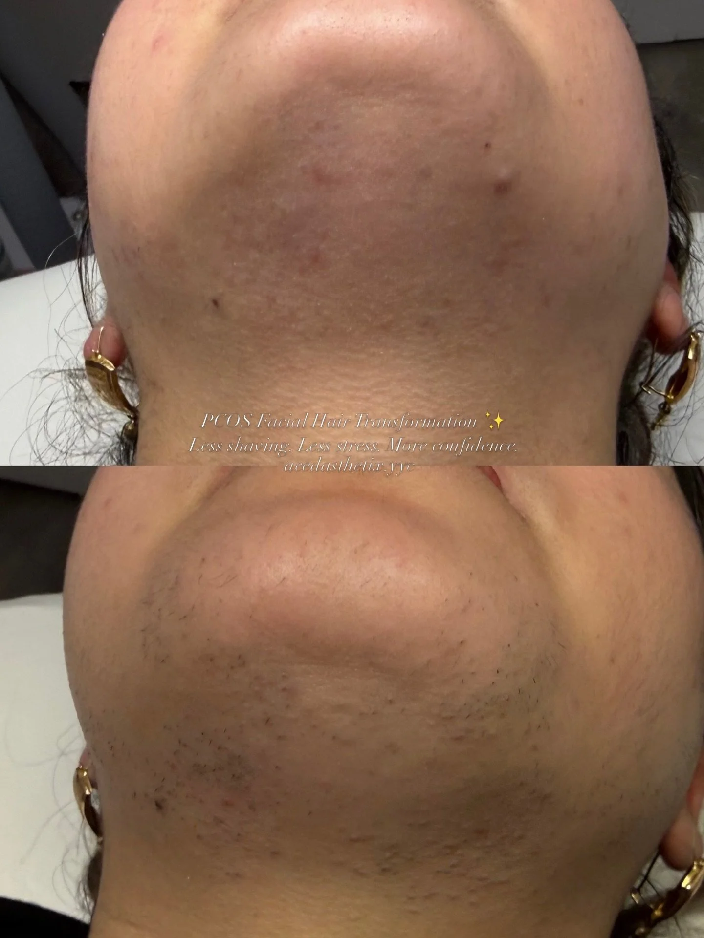 PCOS doesn&rsquo;t have to mean a lifetime of shaving, waxing, and hiding.

This transformation is proof that the right laser hair removal plan can dramatically reduce unwanted facial hair, irritation, ingrown hairs, and the daily stress that comes w