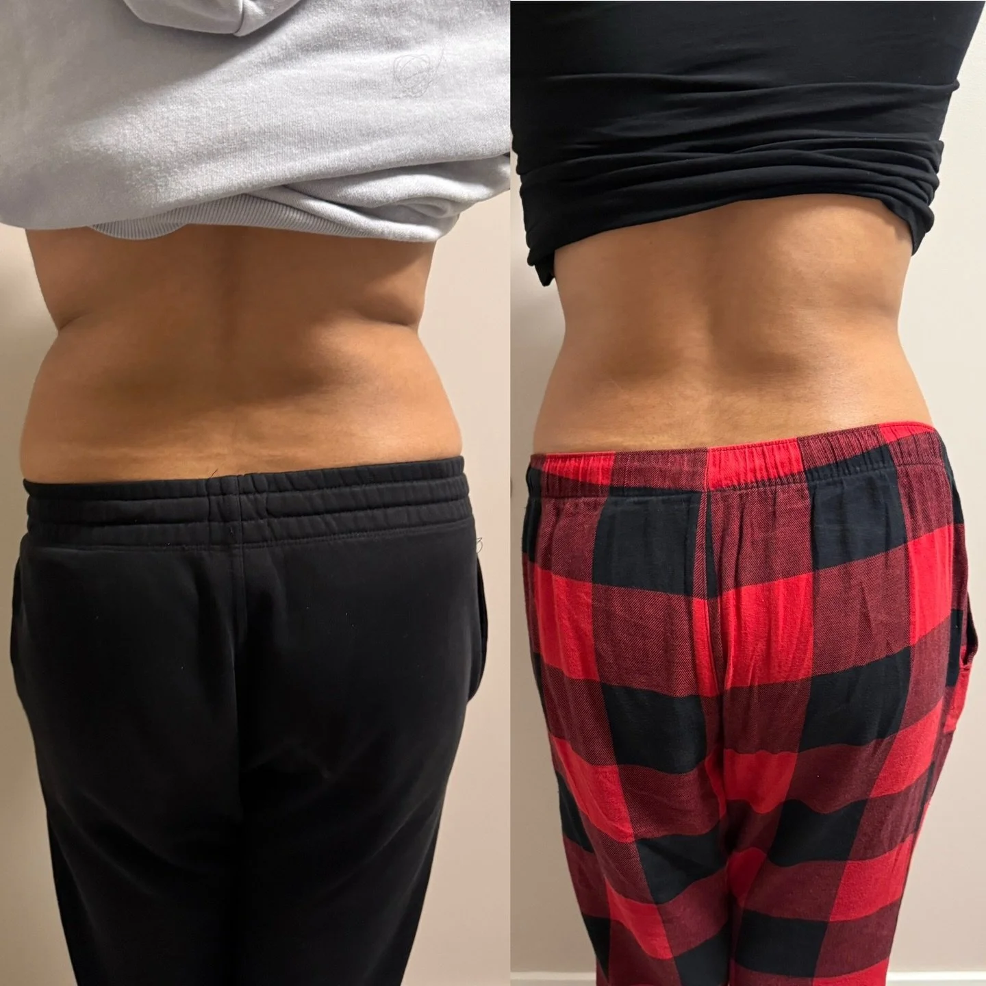 🔥 BACK + LOVE HANDLE SCULPT RESULTS 🔥

Struggling with stubborn back fat or love handles that won&rsquo;t budge despite working out and eating well? You&rsquo;re not alone.

This client&rsquo;s transformation shows how targeted body sculpting can h