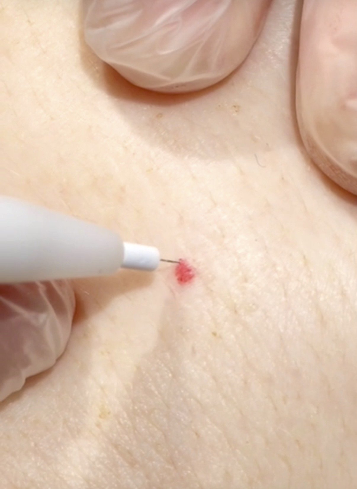 Close-up of a person receiving electrolysis cherry angioma red spot removal at dublin blemish clinic