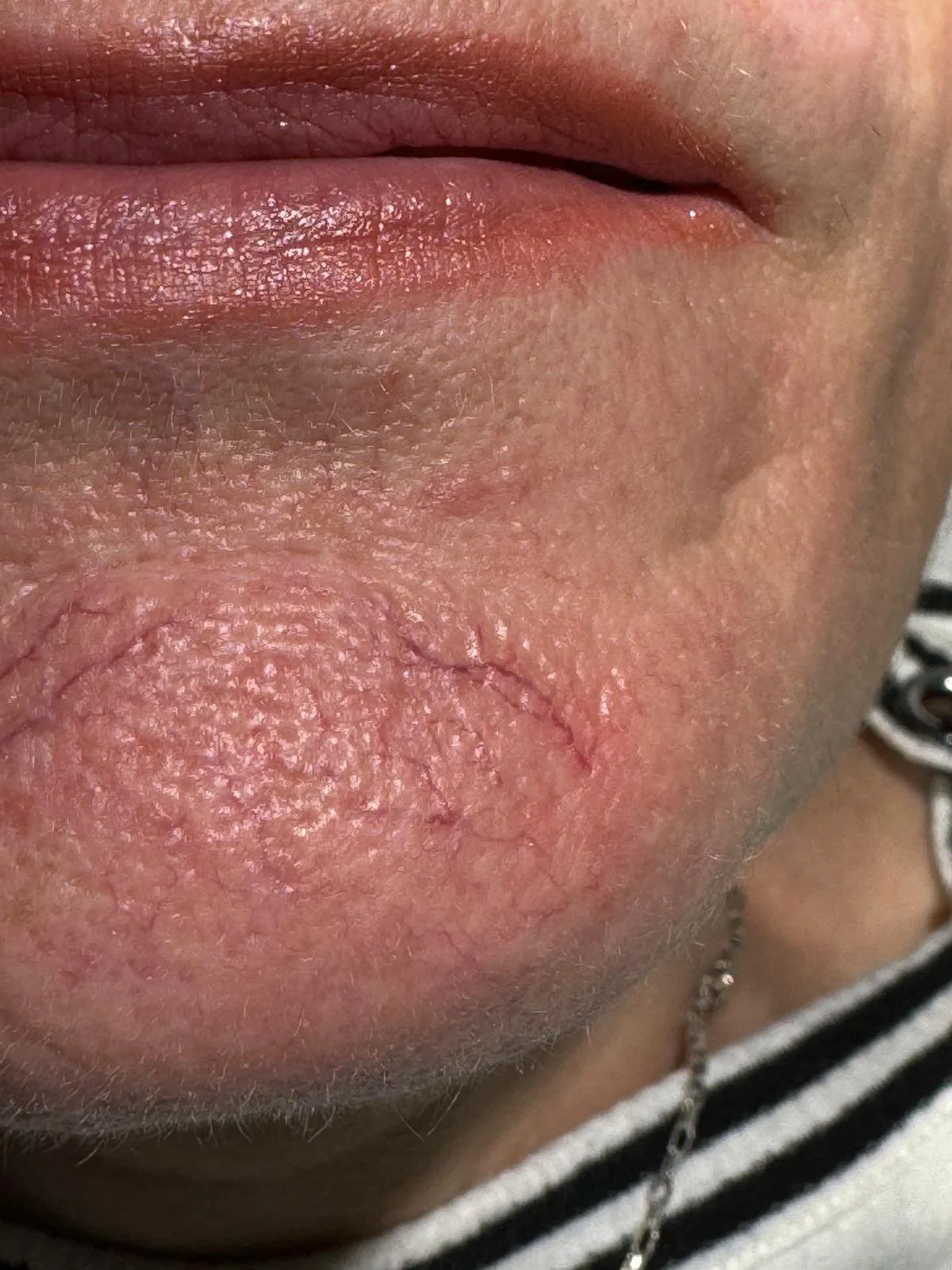 Close-up of a chin with prominent red facial veins before removal at dublin blemish removal clinic