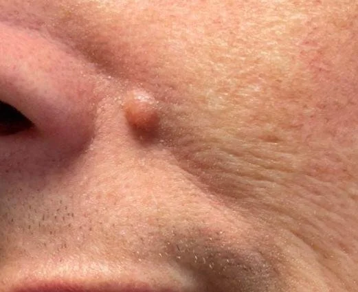 Close-up of a person's cheek with a raised skin bump or Non-Pigment Mole near the nose before removal