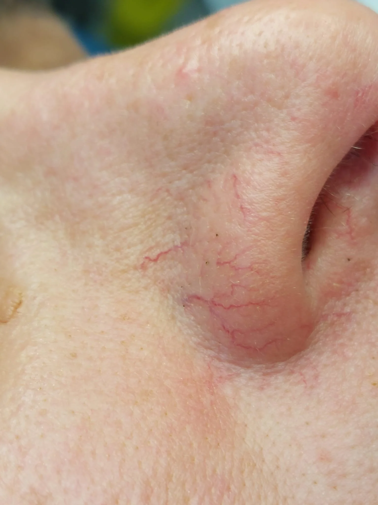Close-up of skin on the nose with broken capillaries and red facial veins before removal at the skin blemish clinic in dublin