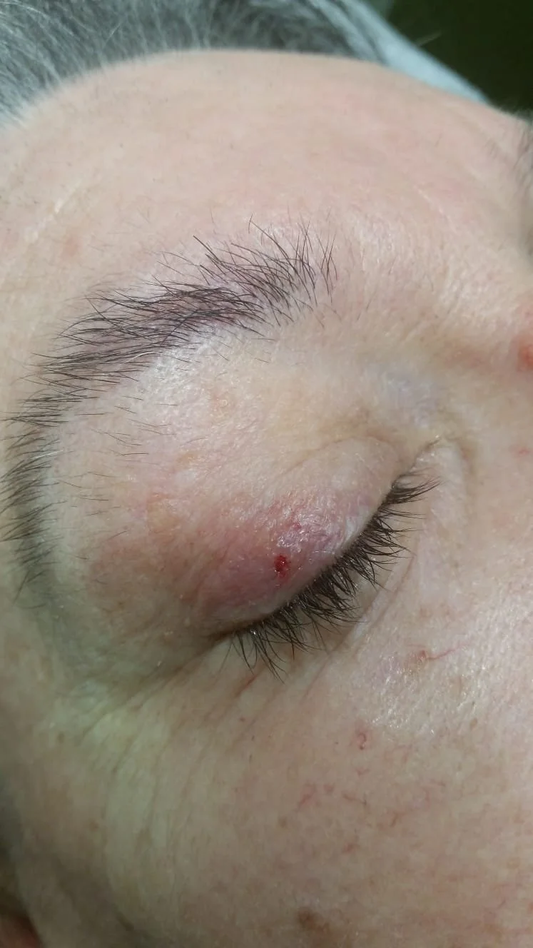 Close-up of a person's closed eye showing a small wound or pimple on the eyelid, with surrounding skin slightly red and irritated.