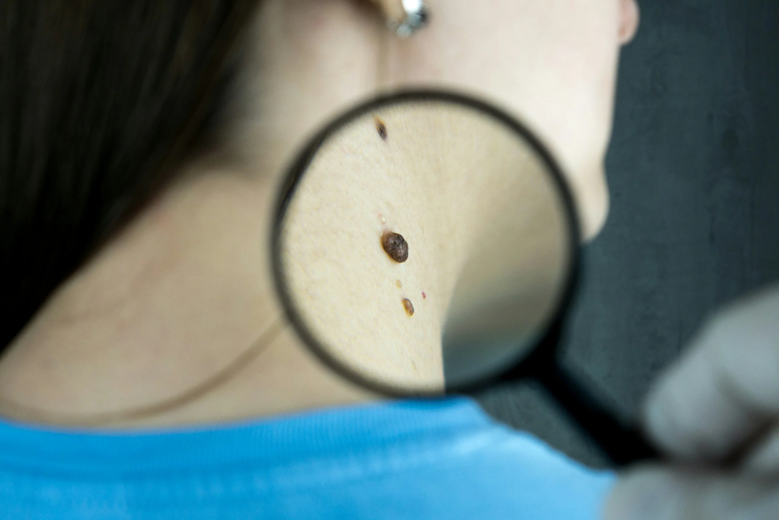Close-up of a person's neck multiple skin tags