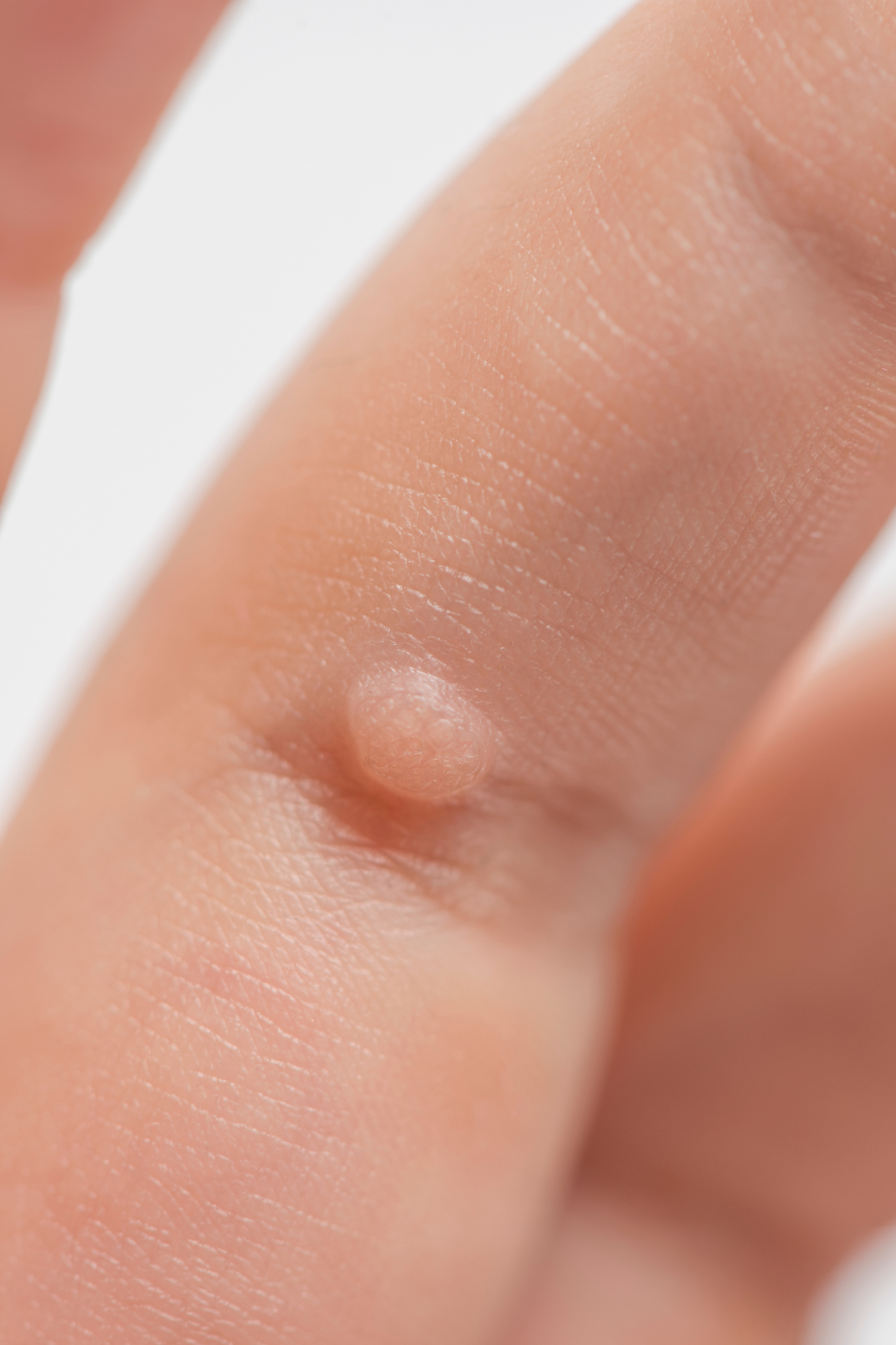 Close-up of common skin skin wart to be removed by The Blemish Removal Clinic In Dublin
