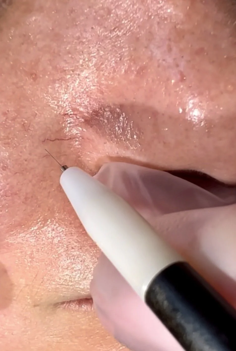 Close-up of a person undergoing a nose thread vein near the nose, with advanced electrolysis