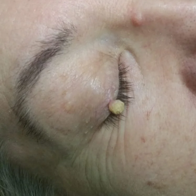 Close-up of a person's face with a large skin tag on the eye lid before removal at the skin blemish clinic in dublin.